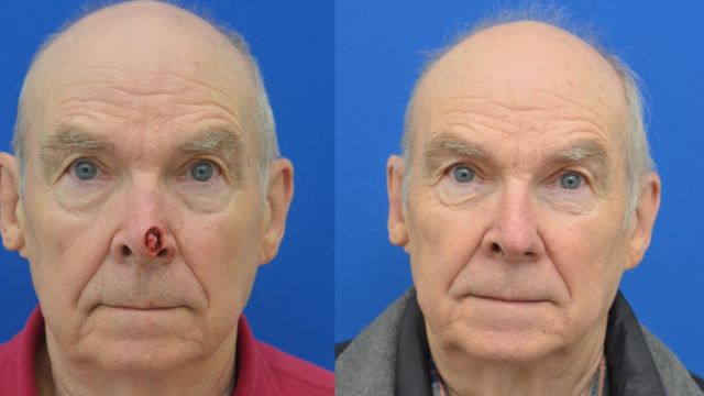 Before and After Mohs Surgery on the Side of the Nose