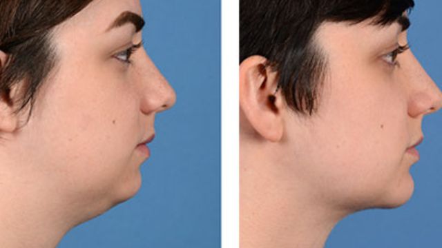 Chin Surgerya Before and After