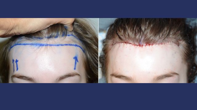 Forehead Reduction Surgery Before and After