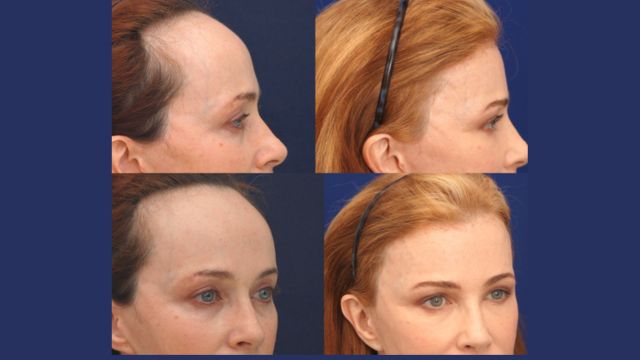 Forehead Reduction Surgery Before and After