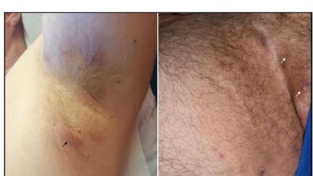 Hidradenitis Suppurativa Surgery Before and After Pictures: A Comprehensive Insight into Treatment Outcomes