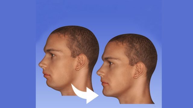 Jawline Surgery Before and After: A Transformative Journey to Facial Harmony