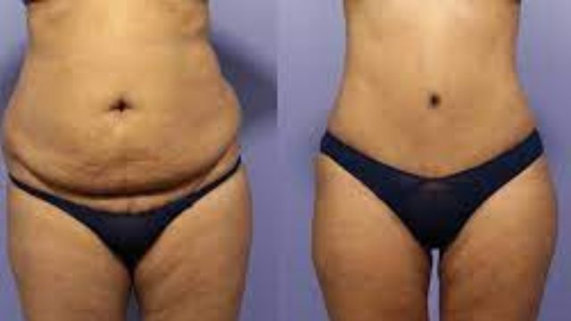 Panniculectomy Surgery Before and After: Transforming Lives and Restoring Confidence