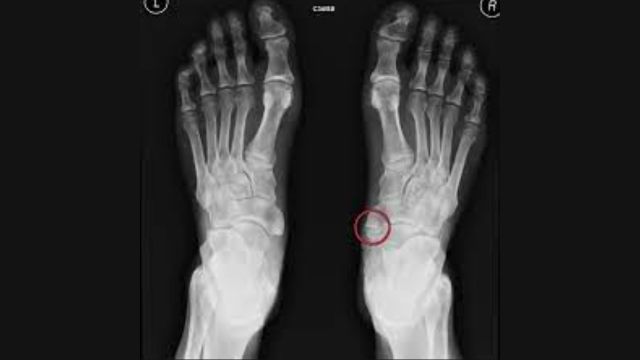 Before and After Accessory Navicular Bone Surgery: A Comprehensive Guide to Recovery and Outcomes