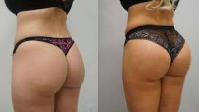 The Definitive Guide to What is BBL Surgery: Enhancing Curves with Brazilian Butt Lift